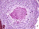 Koligranulomatoza (coligranulomatosis)
